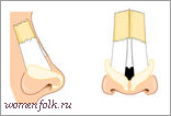 Ринопластика носа Ринопластика носа